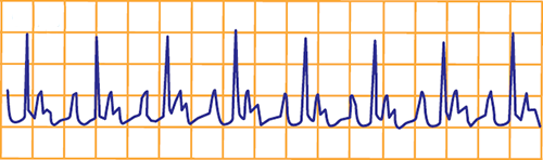 ECG AV block, carotid sinus massage
