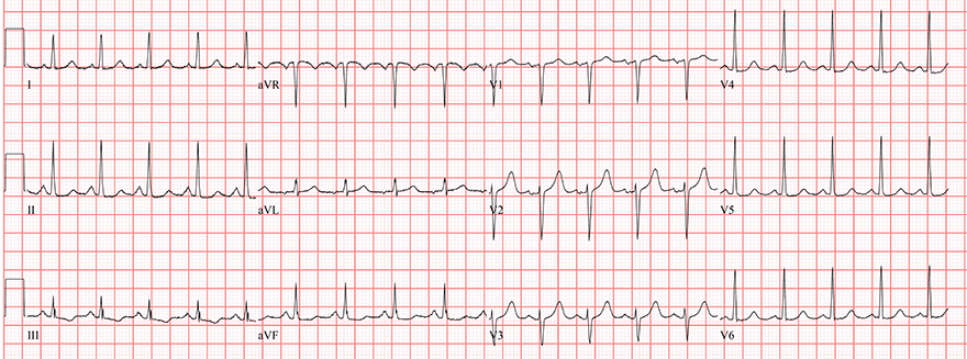 ECG sinus tachycardia vs. Paroxysmal atrial tachycardia (PAT)