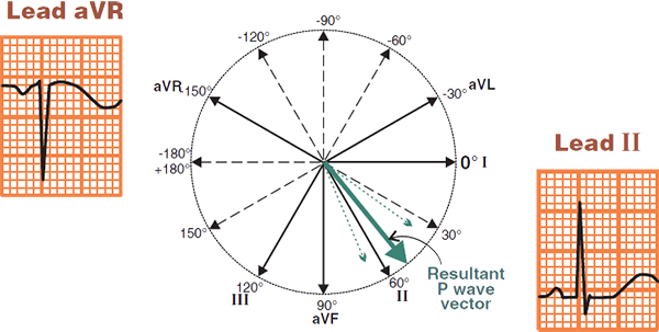 Normal P wave electrical vector, positive P wave II, Inverted P wave aVR lead