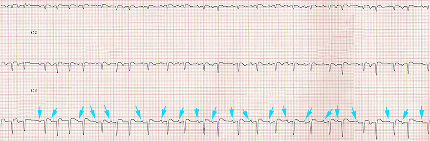 ECG multifocal atrial tachycardia