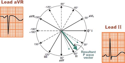 Normal P wave electrical vector, positive P wave II, Inverted P wave aVR lead