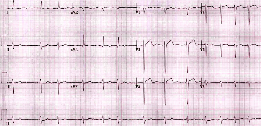 ECG atrial fibrillation, irregular rhythm, no P waves