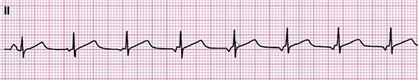 ECG Multifocal atrial arrhythmia