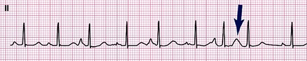 ECG Wandering atrial pacemaker