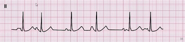 ECG wandering pacemaker