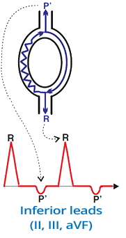 fast-slow AVNRT mechanism