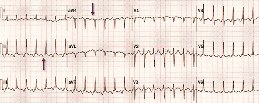 ECG atypical fast-slow AVNRT