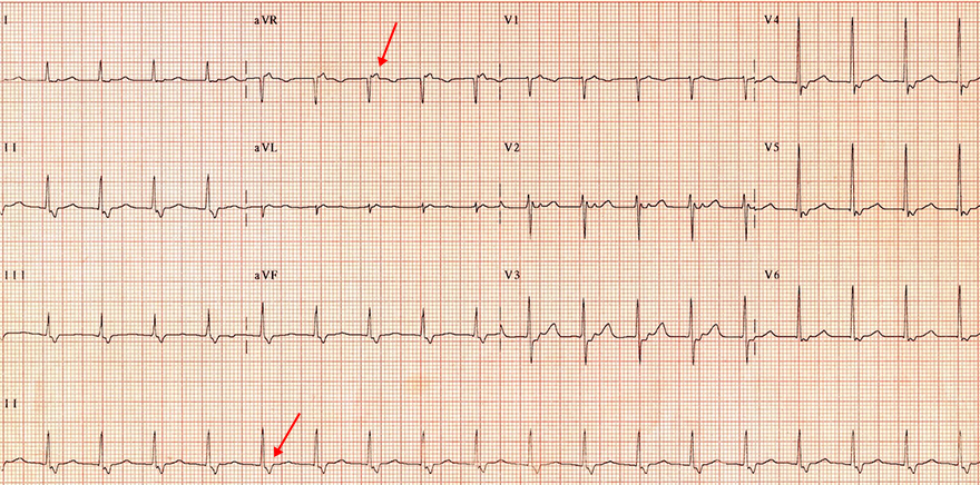 ECG slow-slow AVNRT, RP interval, PR interval