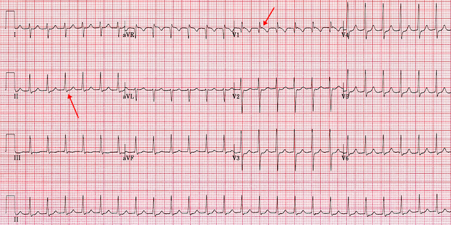 ECG typical slow-fast avnrt, pseudo r wave, pseudo s wave