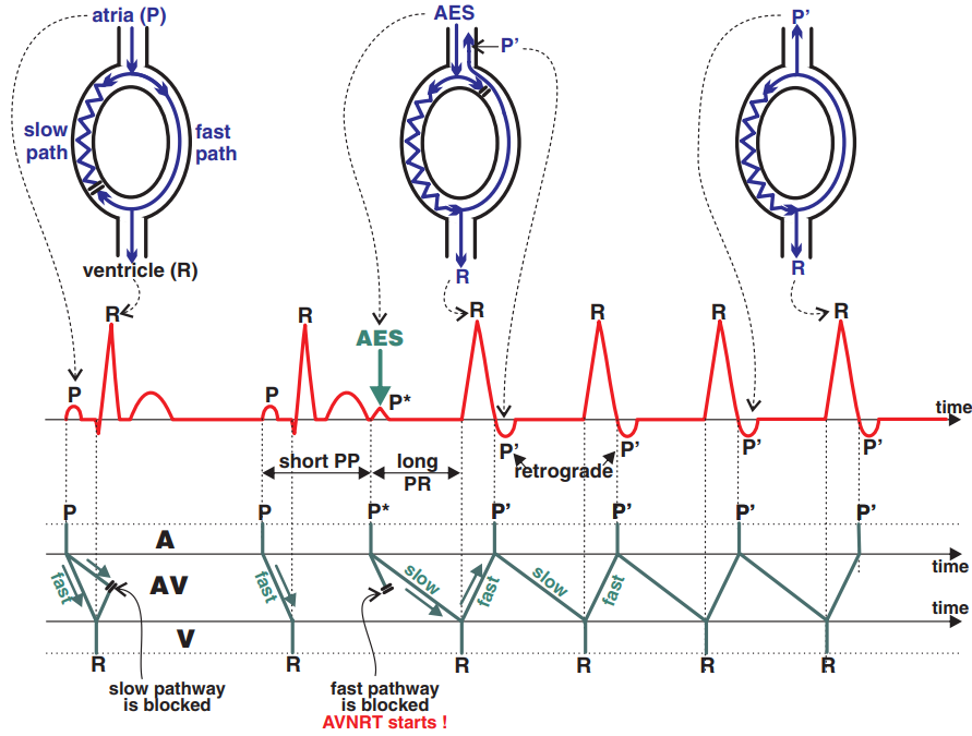 AV Nodal Re entry Tachycardia AVNRT ECG