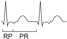 ECG RP, PR interval, short RP tachycardia, long RP tachycardia