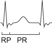 slow fast avnrt, rp pr interval