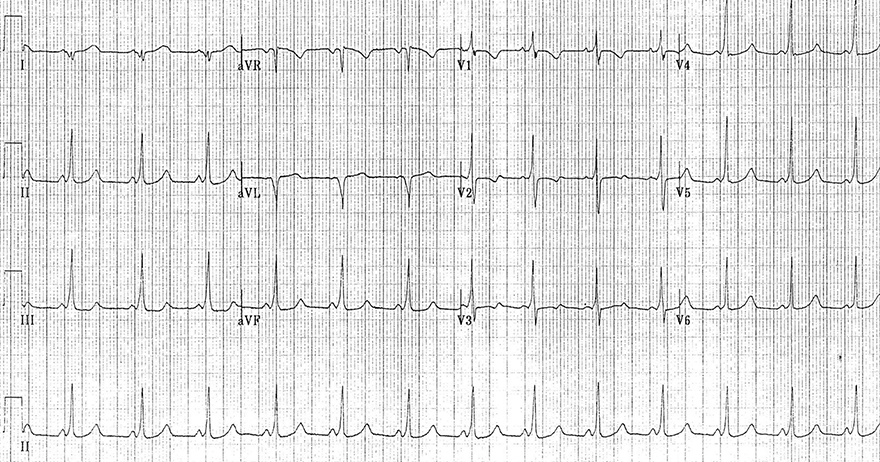 ECG WPW syndrome, AVRT