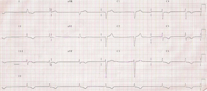 ECG middle av junctional escape rhythm, 45 bpm