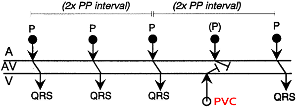 ECG Laddergram, ventricular premature complex, Fully compensatory pause