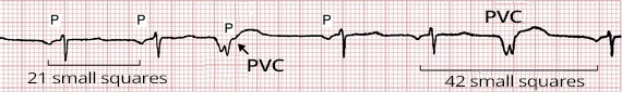 ECG premature ventricular complex, and fully compensatory pause, PP interval