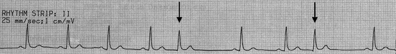 ECG junctional extrasystoles, no p waves, narrow qrs, noncompensatory pause