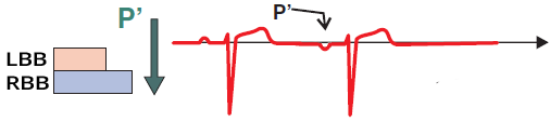 ECG premature junctional complex and sinus rhythm