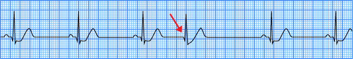 ECG premature junctional complex, no P wave, narrow qrs complex