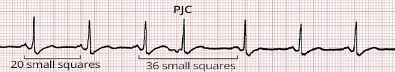 ECG premature junctional complex and non-compensatory pause