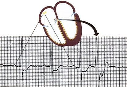 ECG showing AV junction depolarization and Premature Junctional Complex (PJC) with beat and depolarization