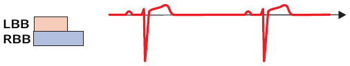 ecg sinus rhythm without aberrant conduction, righ left bundle refractory period