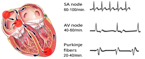 sinus rhythm, junctional ectopic rhythm, ventricular ectopic rhythm