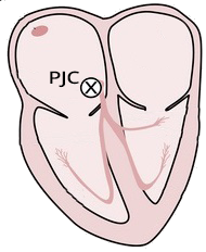 Junctional ectopic focus depolarization, and junctional extrasystoles