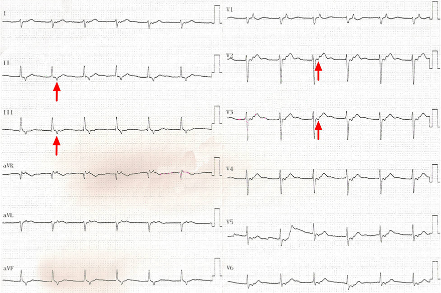 ECG accelerated junctional rhythm, 75 bpm, narrow qrs complexes, retrograde p waves