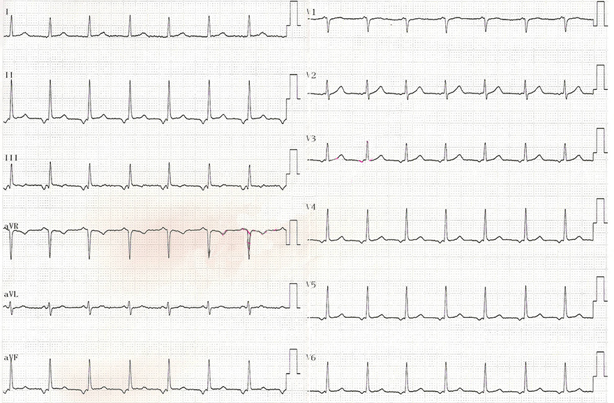 ECG upper av junctional accelerated rhythm, 98 bpm