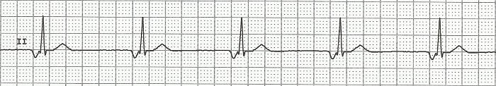 ECG upper junctional rhythm and junctional tachycardia
