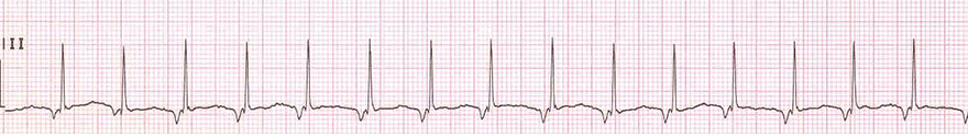 ECG ectopic junctional tachycardia