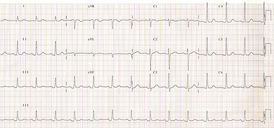 ECG sinus rhythm after avnrt