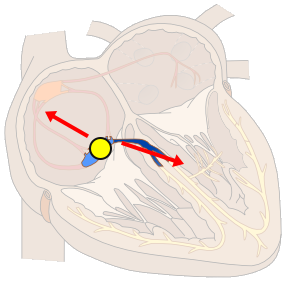 Automatic Junctional Rhythms, enhanced automaticity in AV nodal cells