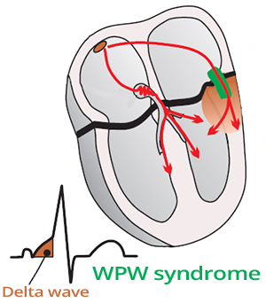 Delta wave, Wolff–Parkinson–White (WPW) syndrome, short PR interval, broad QRS, slurred QRS complex, accessory pathway, bundle of Kent