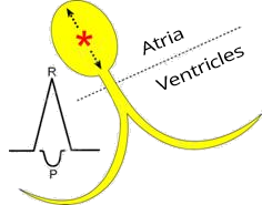 Middle AV junctional rhythm