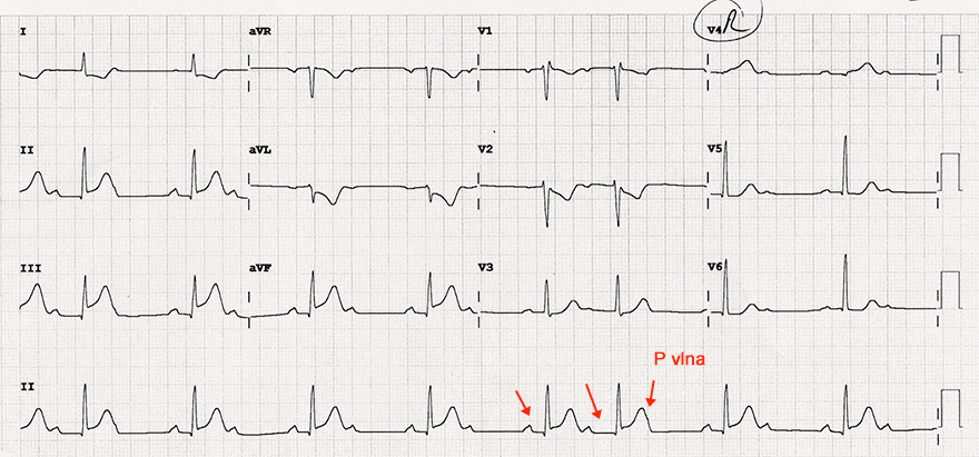 ECG 2nd degree AV block Wenckeback due to Inferior STEMI