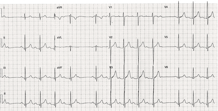 ECG second degree AV block, Mobitz I, PQ interval prolongs from beat to beat