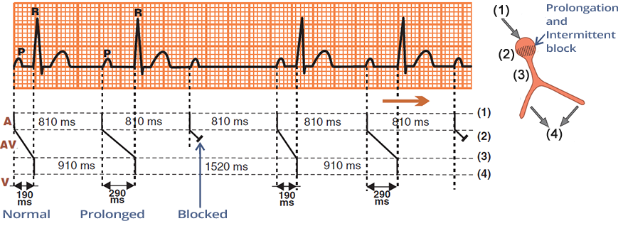ecg laddergram, second av block, mobitz I