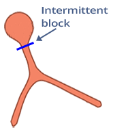 2nd AV block, Mobitz 2, His bundle block (Infranodal block)