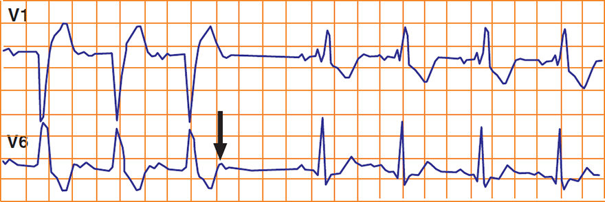 ECG Alternating bundle branch block