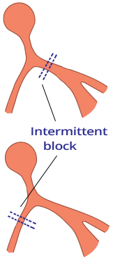 alternating lbbb and rbbb