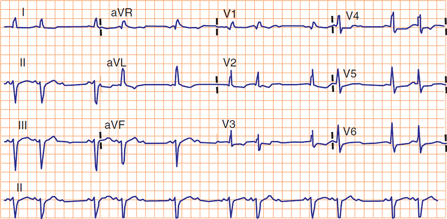 ECG bifascicular block, 2nd degree av block - mobitz 2