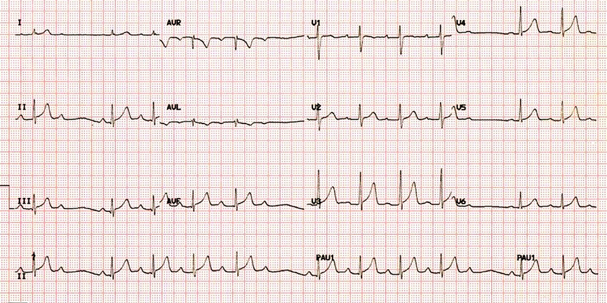 ECG 2nd degree AV block wenckebach, Mobitz I