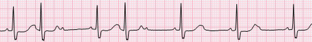 ECG 2nd AV block, Mobitz 2, narrow QRS