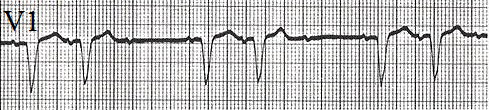 ECG 2nd degree AV block, Mobitz 2, broad QRS