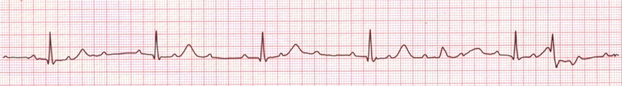 ecg 2nd av block, mobitz 2, first degree av block