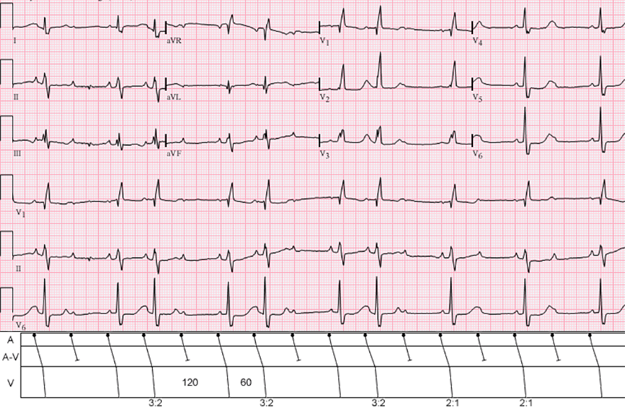 ECG, laddergram: 2nd degree AV block, Mobitz 2