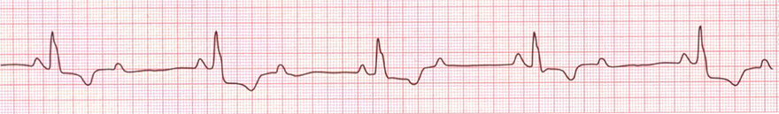 ECG second degree AV block, Mobitz 2, broad qrs complex