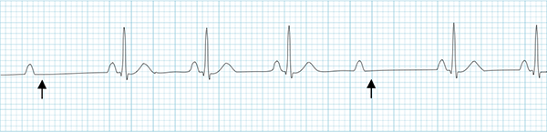ECG second AV block, Mobitz II, non-conducted P waves